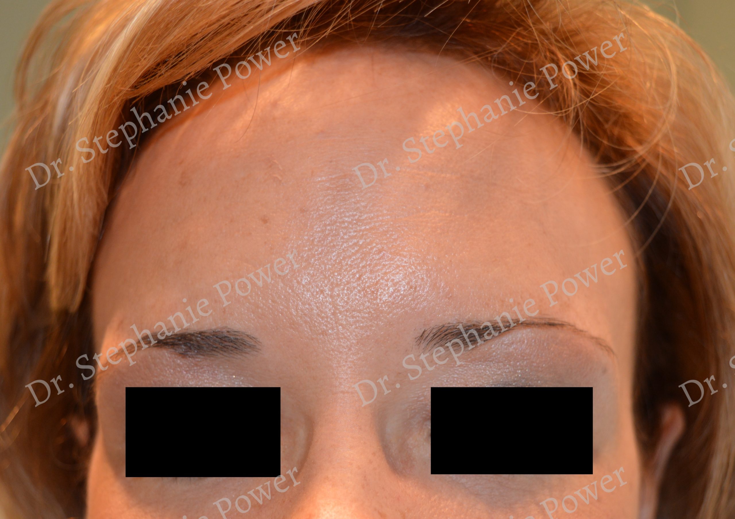https://powerplasticsurgery.blob.core.windows.net/www-powerplasticsurgery-com/uploads/2020/07/Botox_Glabella_post-1-1-Toronto-Ontario-Canada-scaled.jpg
