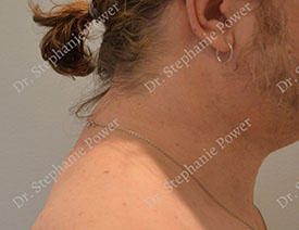 Upper back liposuction, after