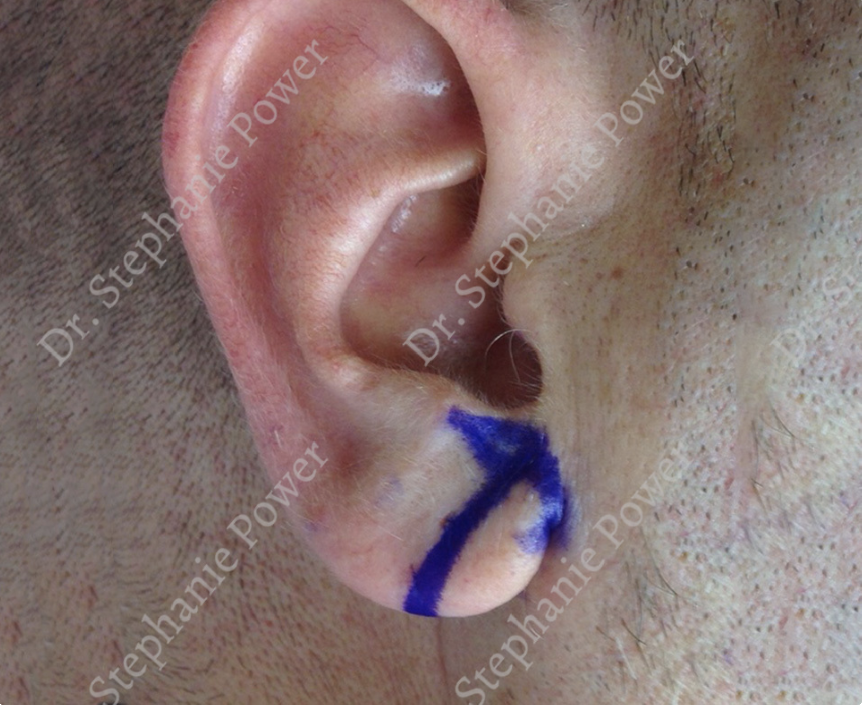 https://powerplasticsurgery.blob.core.windows.net/www-powerplasticsurgery-com/uploads/2020/07/Otoplasty-Before.png