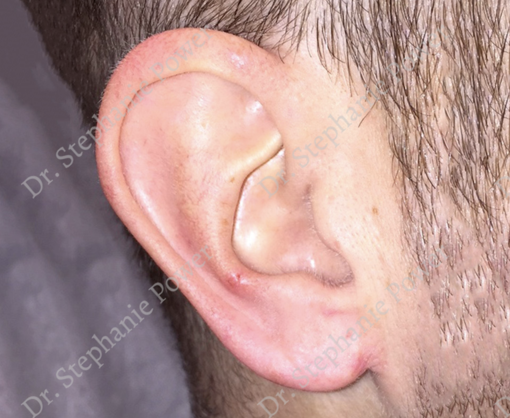 https://powerplasticsurgery.blob.core.windows.net/www-powerplasticsurgery-com/uploads/2020/07/Otoplasty_After.png