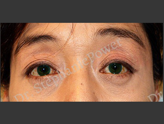 https://powerplasticsurgery.blob.core.windows.net/www-powerplasticsurgery-com/uploads/2020/07/Power_Toronto_Lower-Eyelift_40192_Front_After.png
