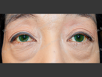 https://powerplasticsurgery.blob.core.windows.net/www-powerplasticsurgery-com/uploads/2020/07/Power_Toronto_Lower-Eyelift_40192_Front_Before.png
