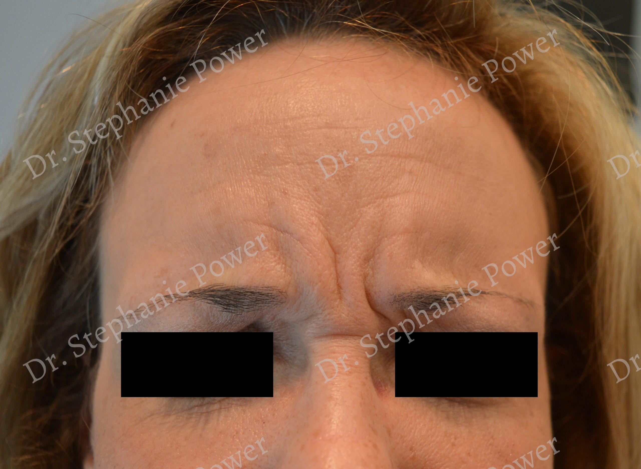 https://powerplasticsurgery.blob.core.windows.net/www-powerplasticsurgery-com/uploads/2020/07/Pre_Botox_Glabella-1-Toronto-Ontario-Canada-scaled.jpg
