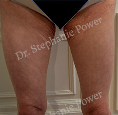 https://powerplasticsurgery.blob.core.windows.net/www-powerplasticsurgery-com/uploads/2020/07/ThighLift_Pre-CROPPED-Toronto-Ontario-Canada.jpg