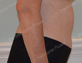https://powerplasticsurgery.blob.core.windows.net/www-powerplasticsurgery-com/uploads/2020/07/TummyTuck_6_months_post_side_pv-Toronto-Ontario-Canada.jpg