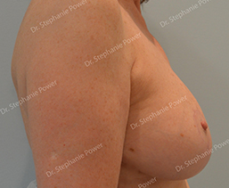 https://powerplasticsurgery.blob.core.windows.net/www-powerplasticsurgery-com/uploads/2020/07/breast-lift-post-op-WM-side_cropped-Toronto-Ontario-Canada.jpg