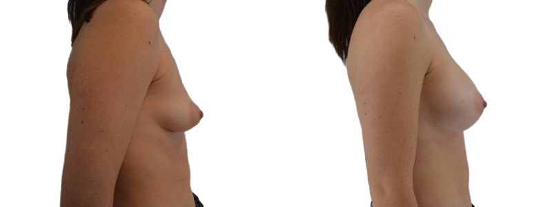 Power ps gallery breast augmentation 20900 right.jpg — Power Plastic Surgery
