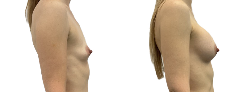 Power ps gallery breast augmentation 18154 right.jpg — Power Plastic Surgery