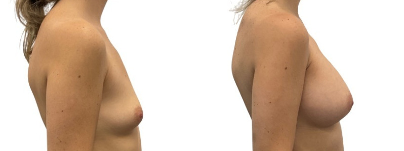 Breast augmentation merged 11.jpg — Power Plastic Surgery