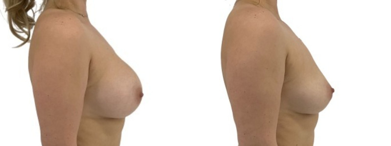 Breast implant removal merged 1.jpg — Power Plastic Surgery