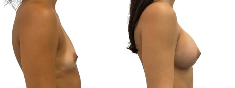 Breast augmentation merged 11.jpg — Power Plastic Surgery