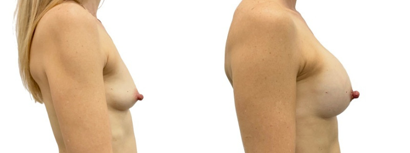 Breast augmentation merged 13.jpg — Power Plastic Surgery