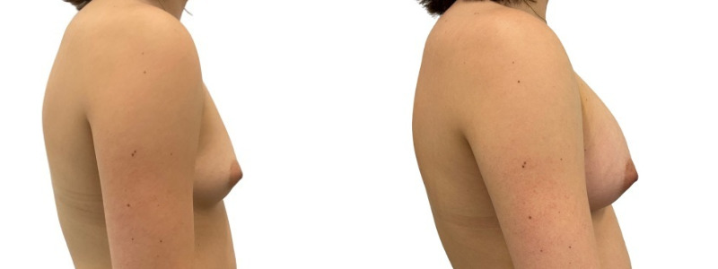 Breast augmentation merged 15.jpg — Power Plastic Surgery