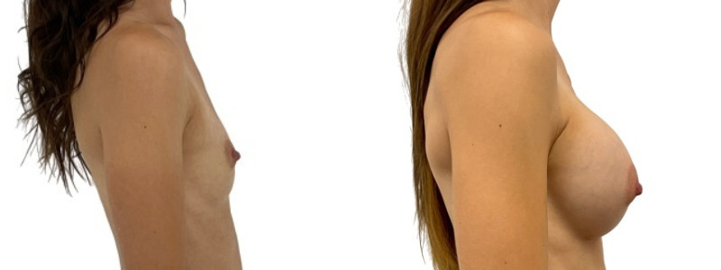 Breast augmentation merged 17.jpg — Power Plastic Surgery