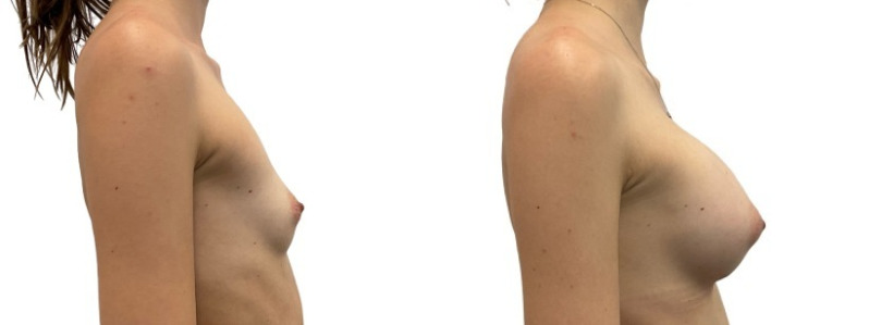 Breast augmentation merged 19.jpg — Power Plastic Surgery