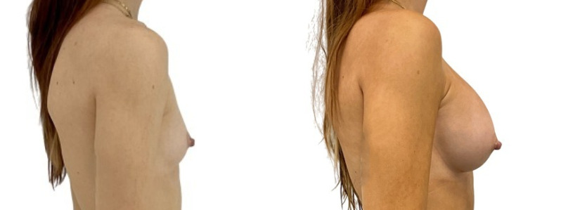 Breast augmentation merged 23.jpg — Power Plastic Surgery