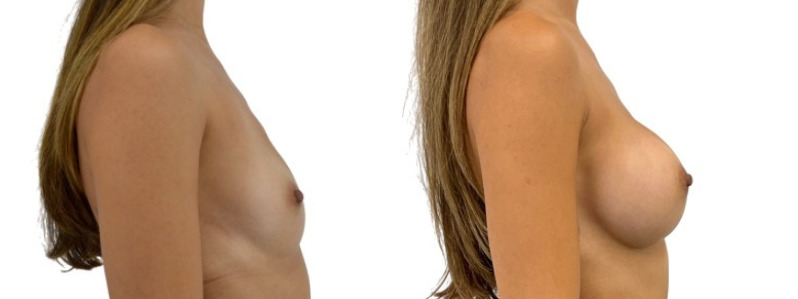 Breast augmentation merged 29.jpg — Power Plastic Surgery