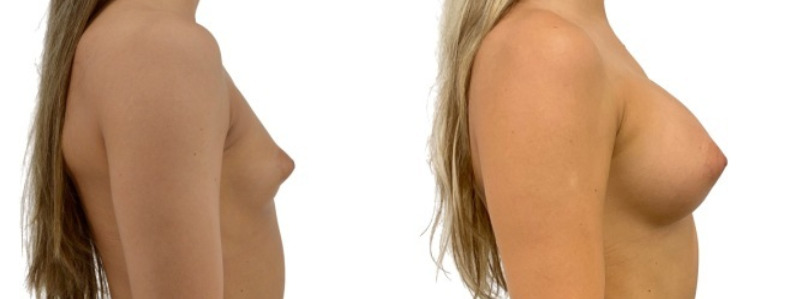 Breast augmentation merged 31.jpg — Power Plastic Surgery
