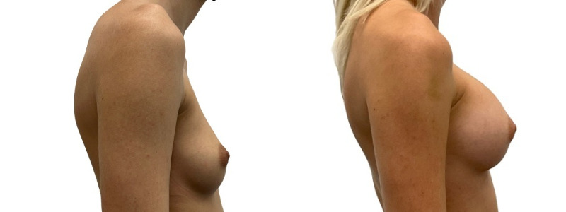 Breast augmentation merged 9.jpg — Power Plastic Surgery