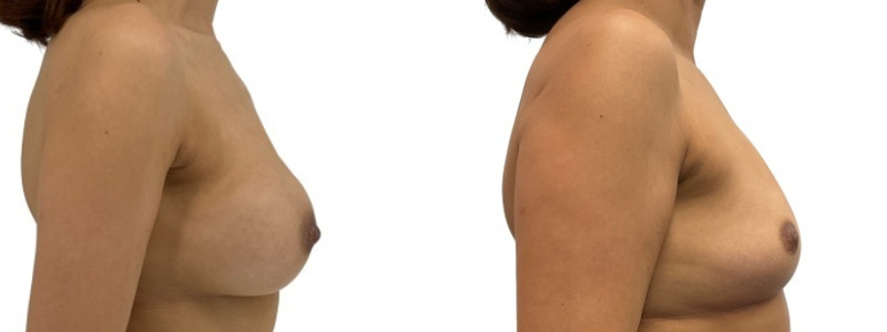 Breast implant removal merged 1.jpg — Power Plastic Surgery