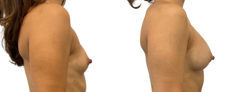 Breast implant revision before and after, patient of Dr. Stephanie Power in Toronto