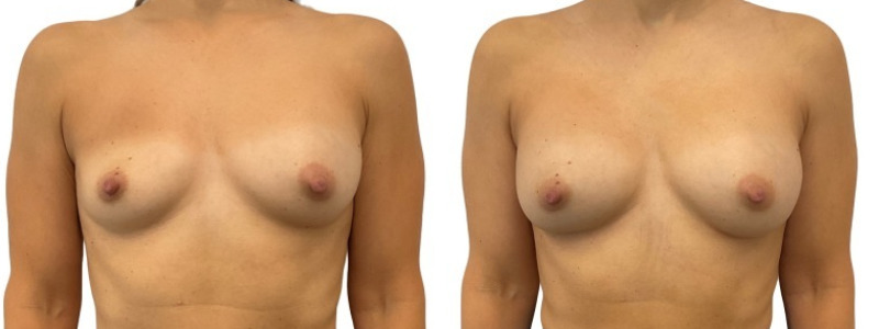 Breast implant revision before and after, patient of Dr. Stephanie Power in Toronto