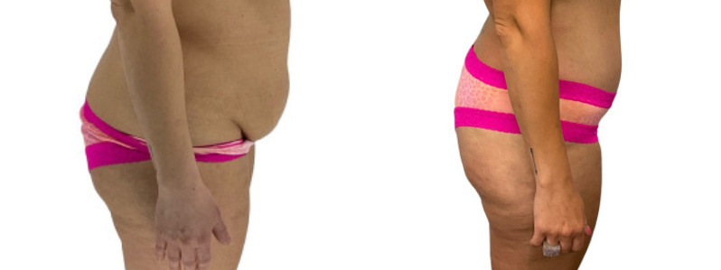 Liposuction before and after, patient of Dr. Stephanie Power in Toronto