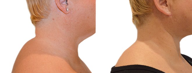 Liposuction before and after, patient of Dr. Stephanie Power in Toronto