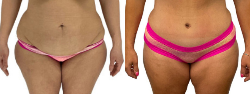 Liposuction before and after, patient of Dr. Stephanie Power in Toronto