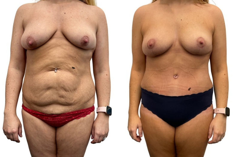 Mommy Makeover before and after, real patient of Dr. Stephanie Power in Toronto