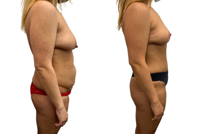Mommy Makeover before and after, real patient of Dr. Stephanie Power in Toronto
