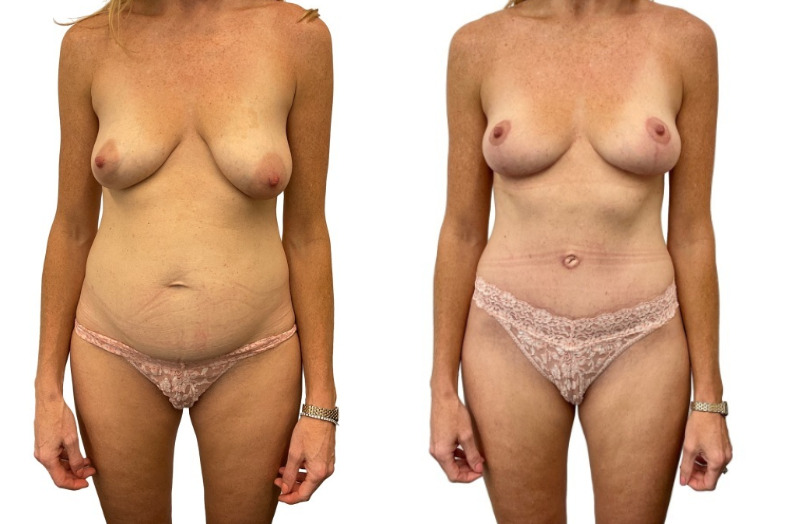 Mommy Makeover before and after, real patient of Dr. Stephanie Power in Toronto