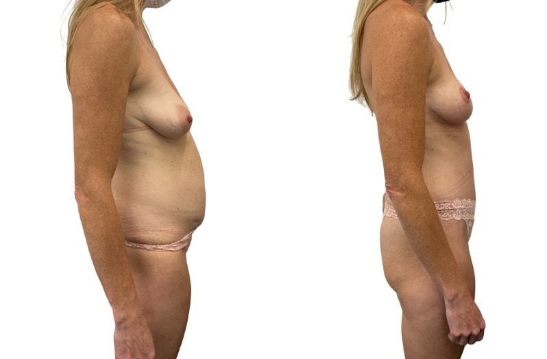 Mommy Makeover before and after, real patient of Dr. Stephanie Power in Toronto