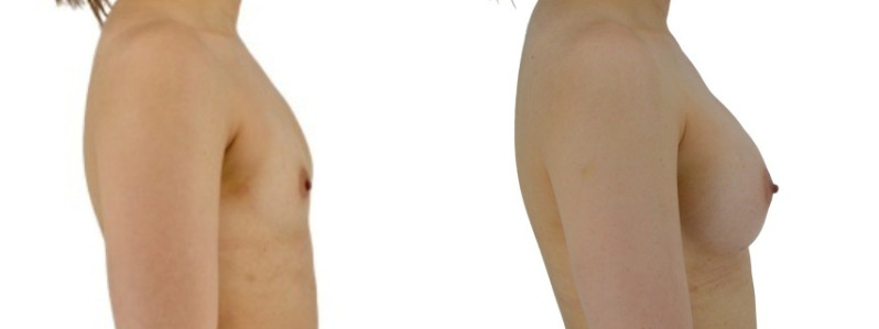 Breast augmentation merged 1.jpg — Power Plastic Surgery
