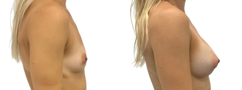 Breast augmentation merged 3.jpg — Power Plastic Surgery