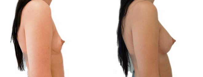 Breast augmentation merged 7.jpg — Power Plastic Surgery