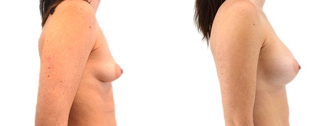 Breast augmentation merged 9.jpg — Power Plastic Surgery
