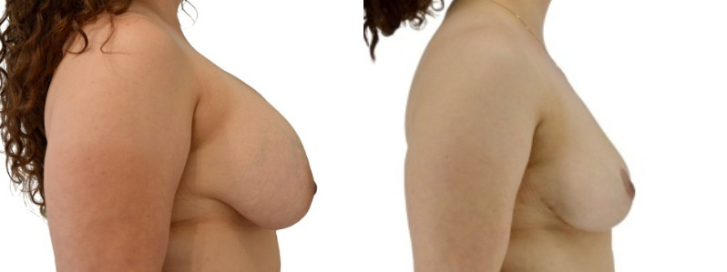 Breast lift merged 1.jpg — Power Plastic Surgery