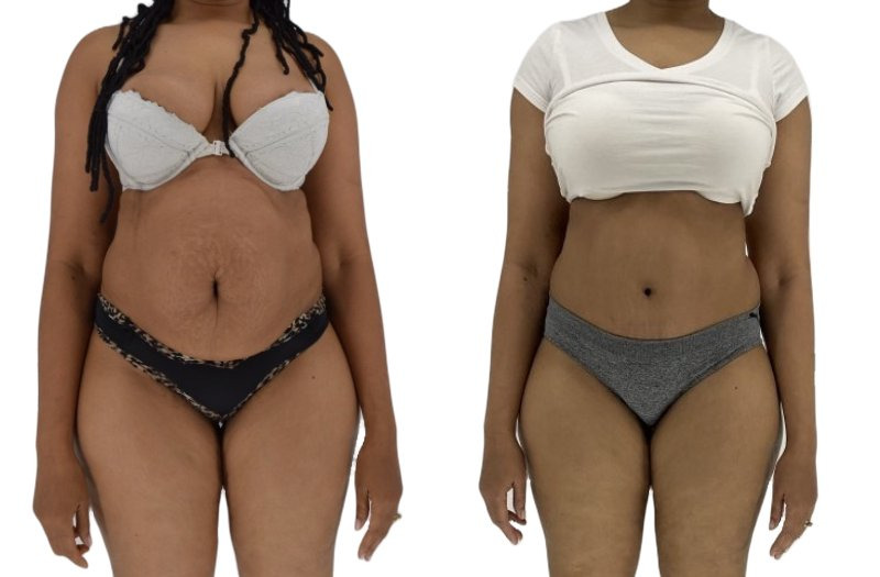 Tummy Tuck before and after, real patient of Dr. Stephanie Power in Toronto