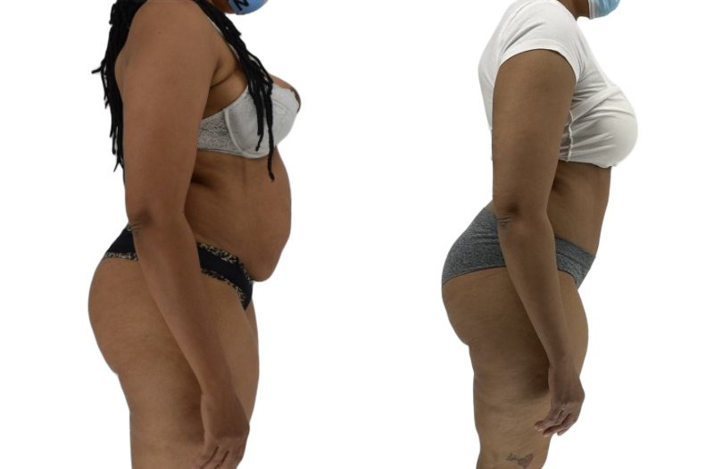 Tummy Tuck before and after, real patient of Dr. Stephanie Power in Toronto