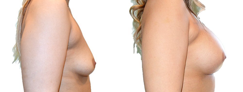 Breast augmentation merged 17.jpg — Power Plastic Surgery