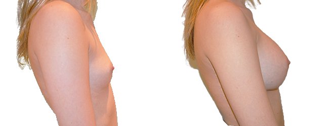 Breast augmentation merged 19.jpg — Power Plastic Surgery