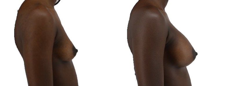 Breast augmentation merged 27.jpg — Power Plastic Surgery