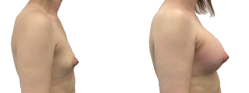 Breast augmentation merged 40.jpg — Power Plastic Surgery