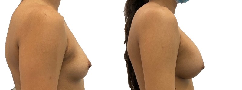 Breast augmentation merged 42.jpg — Power Plastic Surgery