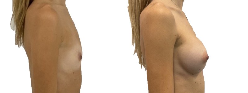 Breast augmentation merged 44.jpg — Power Plastic Surgery