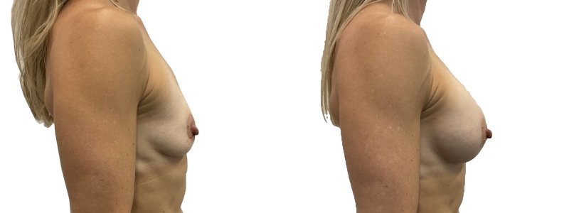 Breast augmentation merged 46.jpg — Power Plastic Surgery