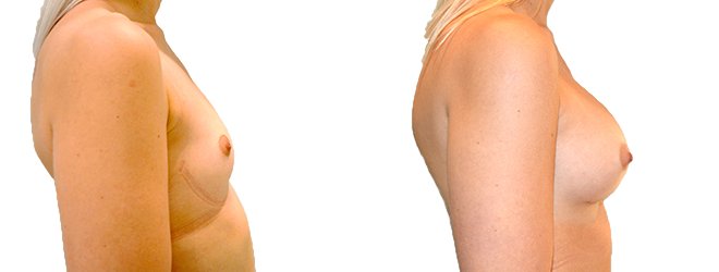 Breast augmentation merged 5.jpg — Power Plastic Surgery