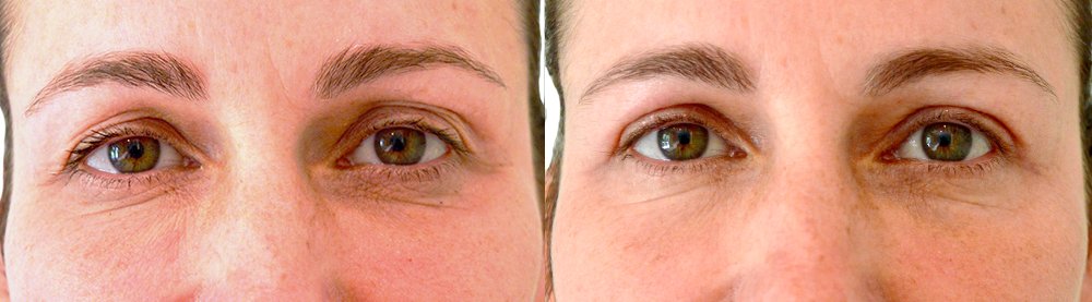 Eyelid surgery before and after, patient of Dr. Stephanie Power in Toronto