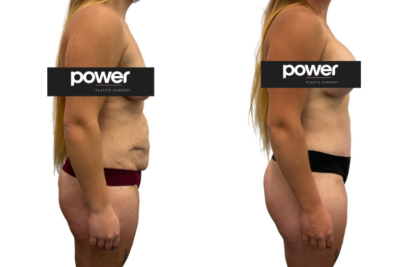 Tummy Tuck before and after, real patient of Dr. Stephanie Power in Toronto